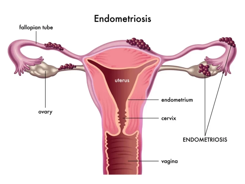 Best Endometriosis Treatment In Hyderabad