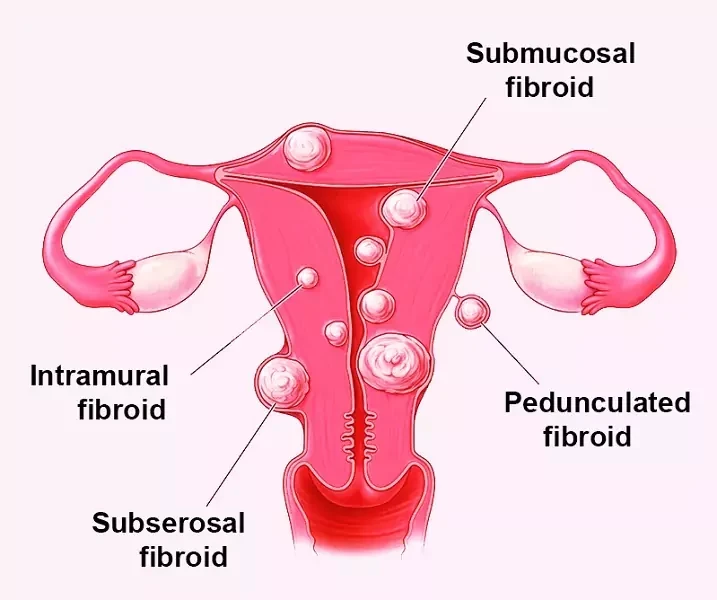 Fibroids