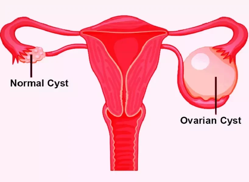 Ovarian Cysts