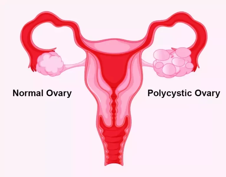 PCOS