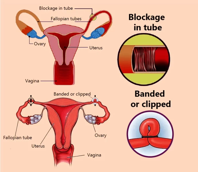 tubal recanalization