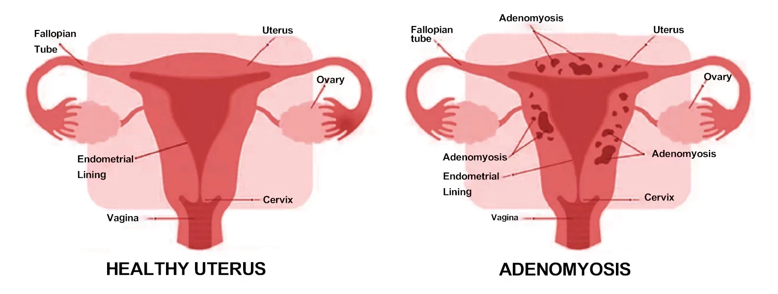 Adenomyosis