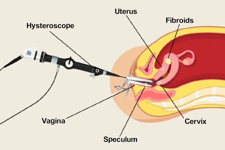 Hysteroscopic surgeries