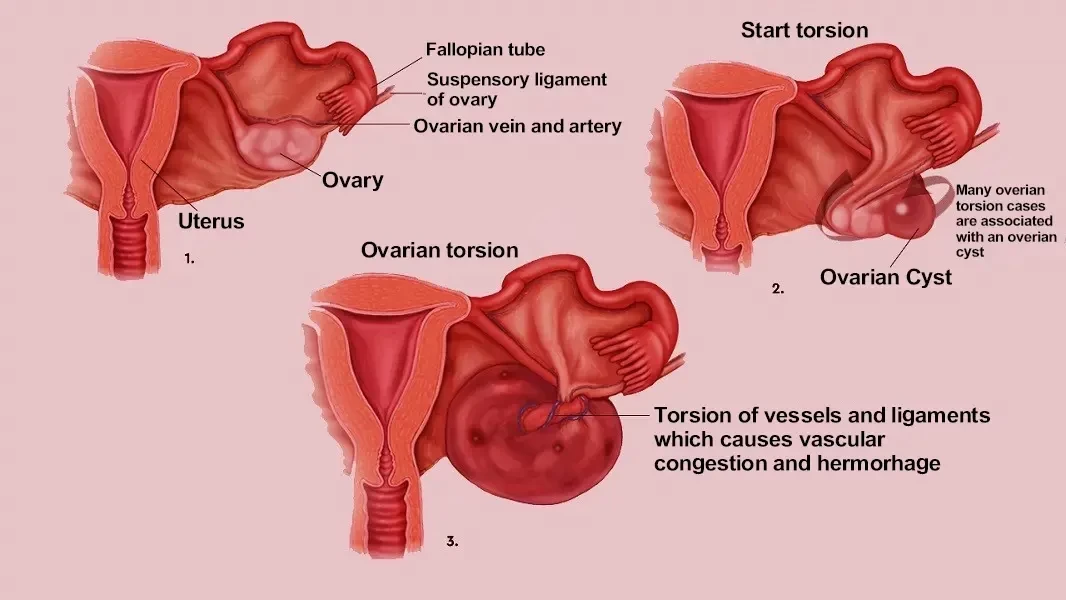 Ovarian Cystic Torsion