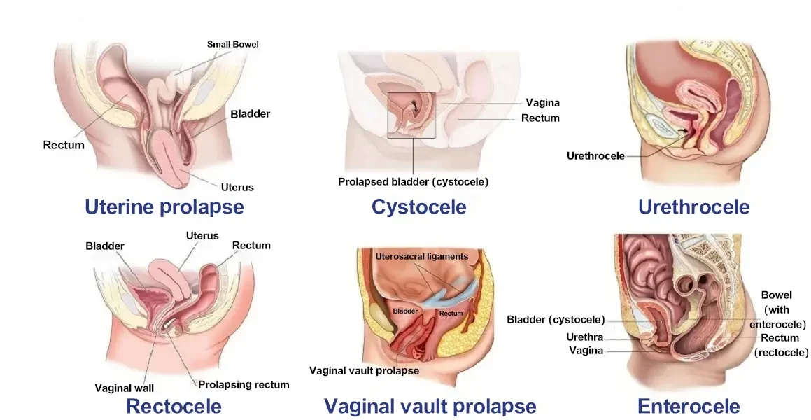 Uterine Prolapse