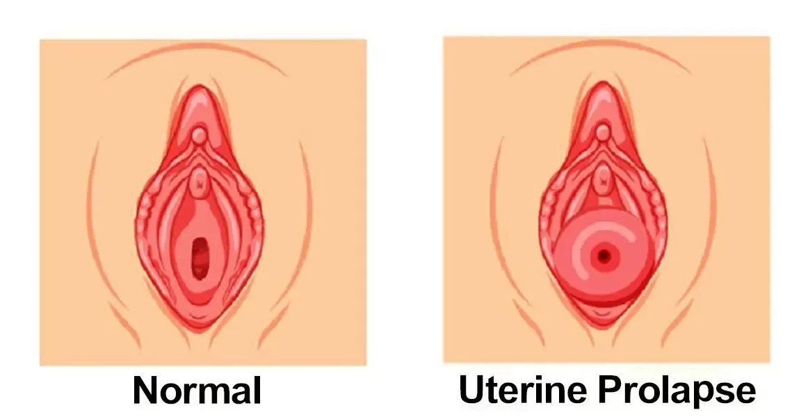 Uterine Prolapse