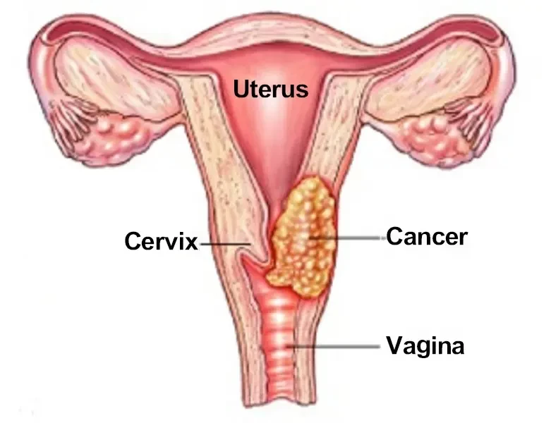 Uterus Cancer