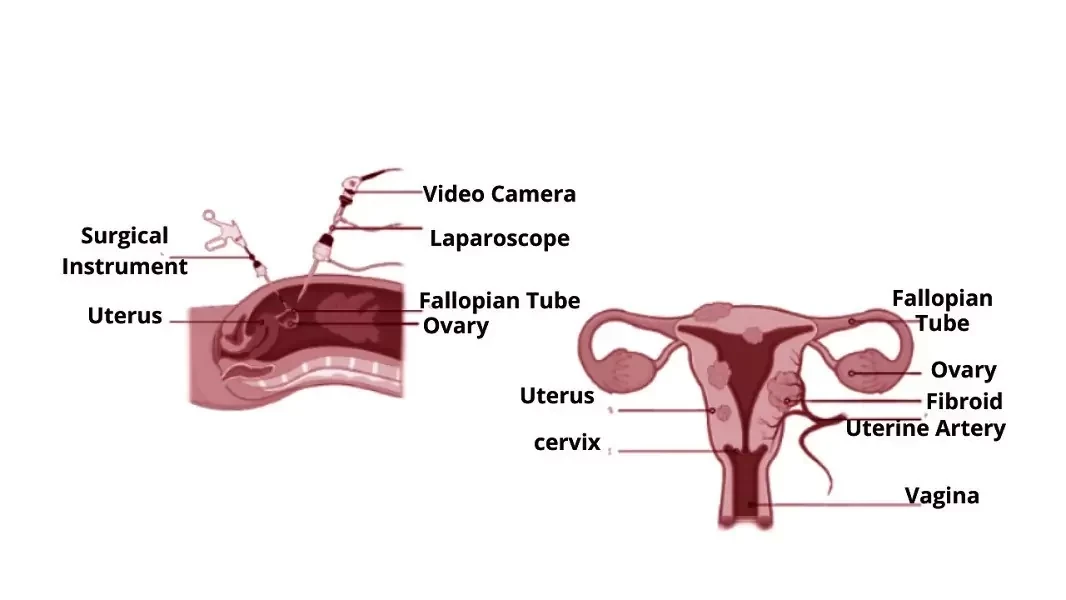 Laparoscopic Myomectomy