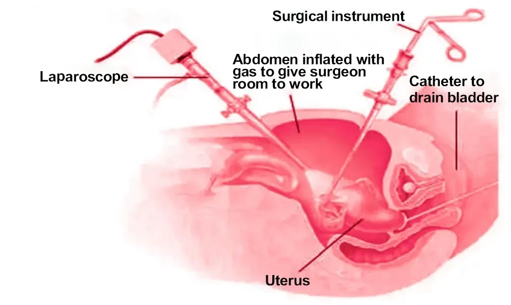 Laparoscopic Hysterectomy