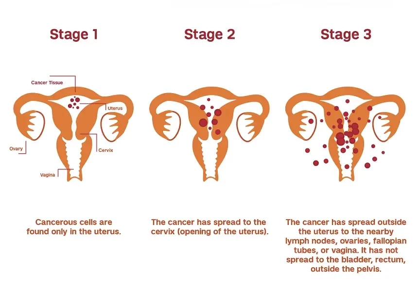 Uterine Cancer Surgery