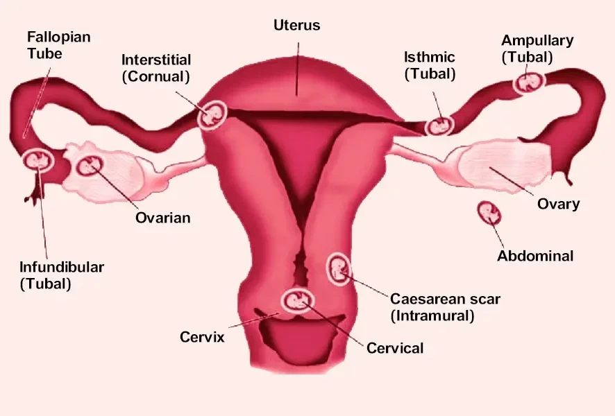 Ectopic Pregnancy