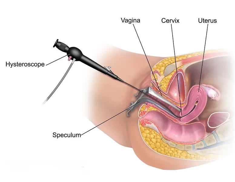 Hysteroscopy With Biopsy