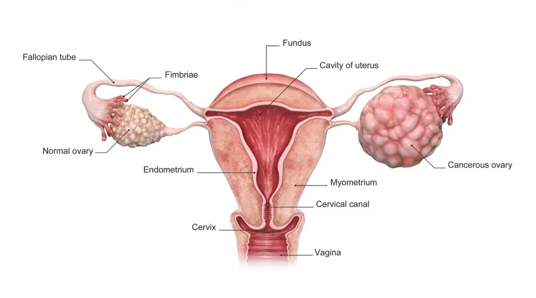 Ovarian Cancer
