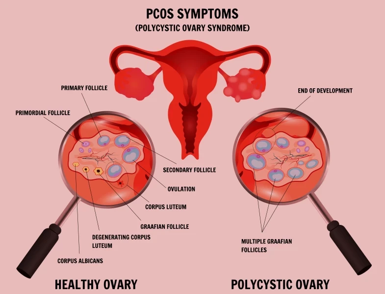 PCOS