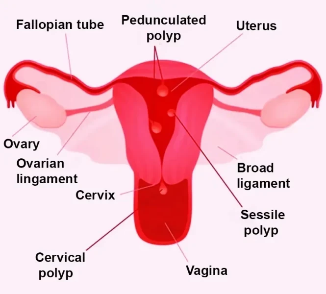 Uterine Polyps