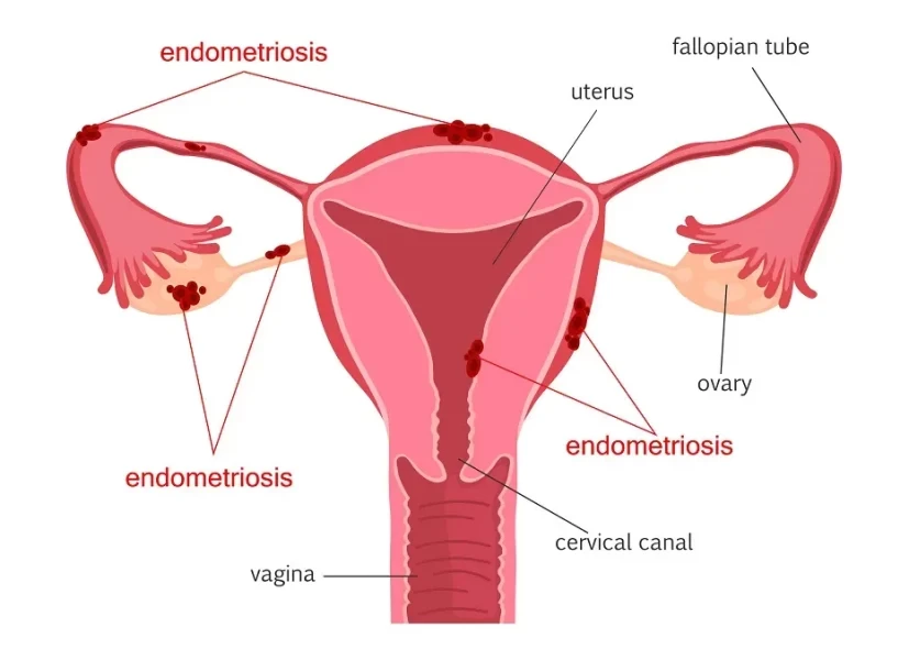 Endometriosis Surgery