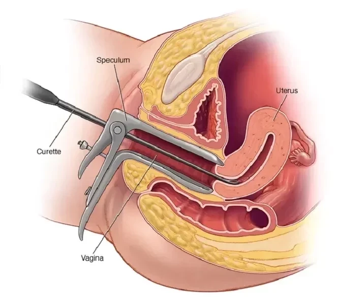 Dilation And Curettage (D And C)