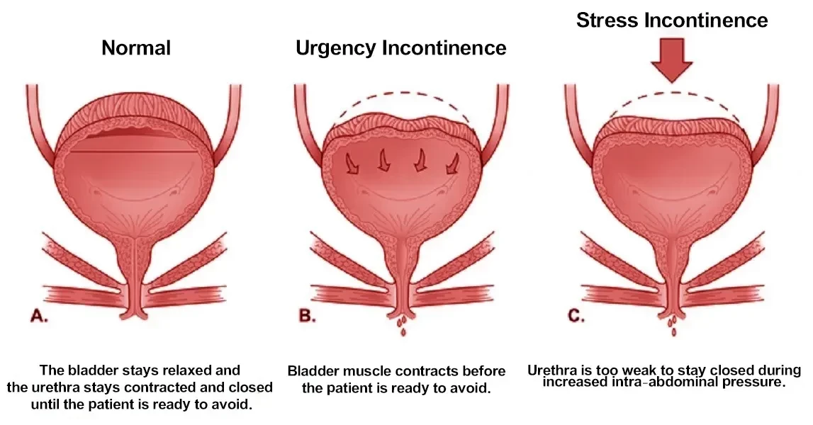 Urinary Incontinence